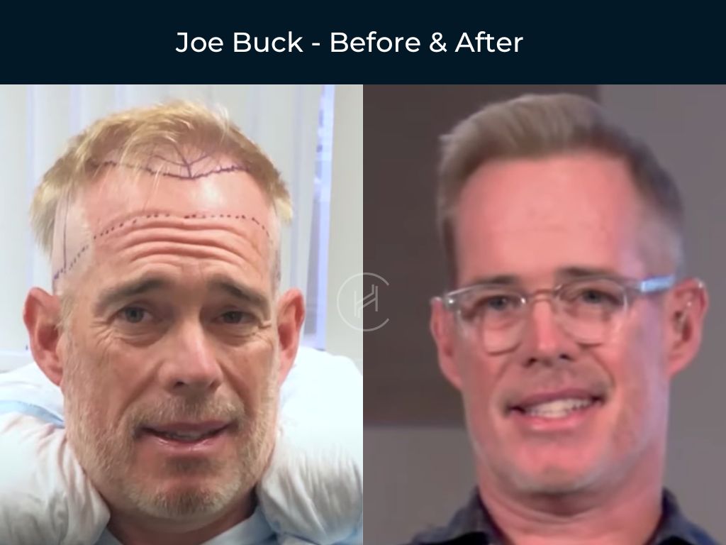 Joel Mchale Hair Transplant