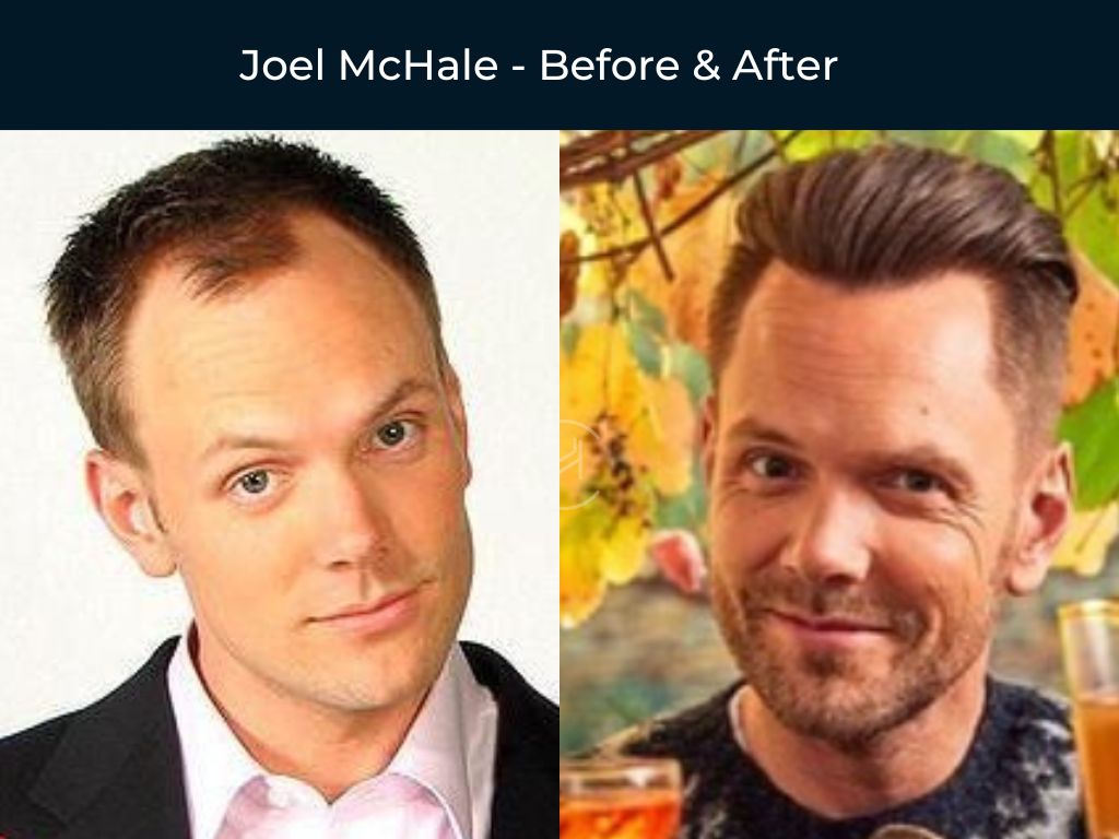 Joel McHale - Hair Transplant Before & After