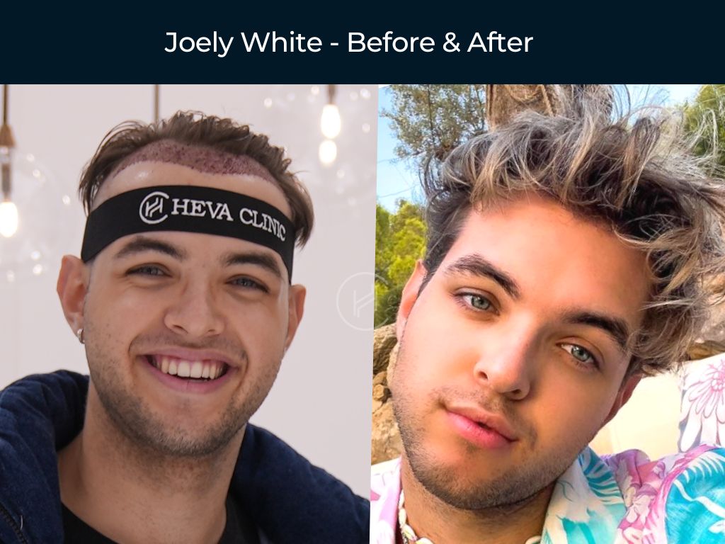 Joely White - Hair Transplant Before & After