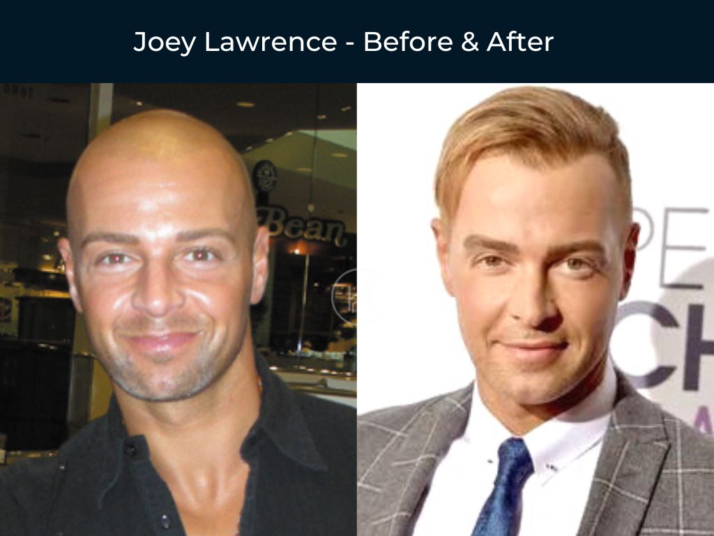 56 Celebrity Hair Transplants | Before & After Photos
