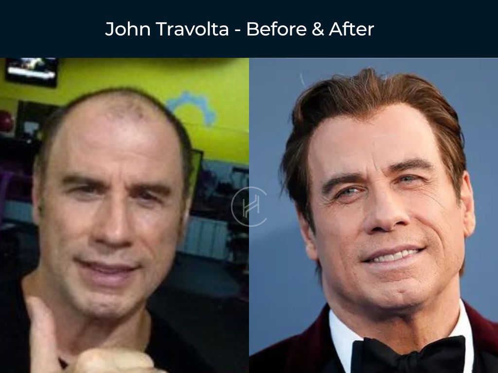 John Travolta - Hair Transplant Before & After
