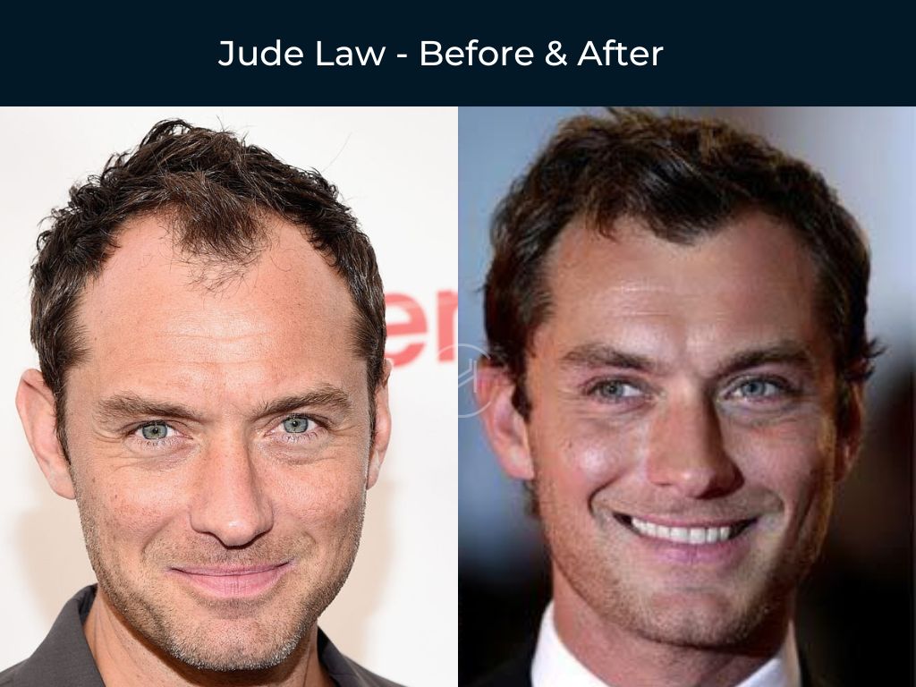 56 Celebrity Hair Transplants | Before & After Photos 56 Celebrity Hair Transplants | Before & After Photos