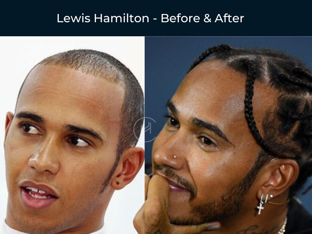 Lewis Hamilton - Hair Transplant Before & After
