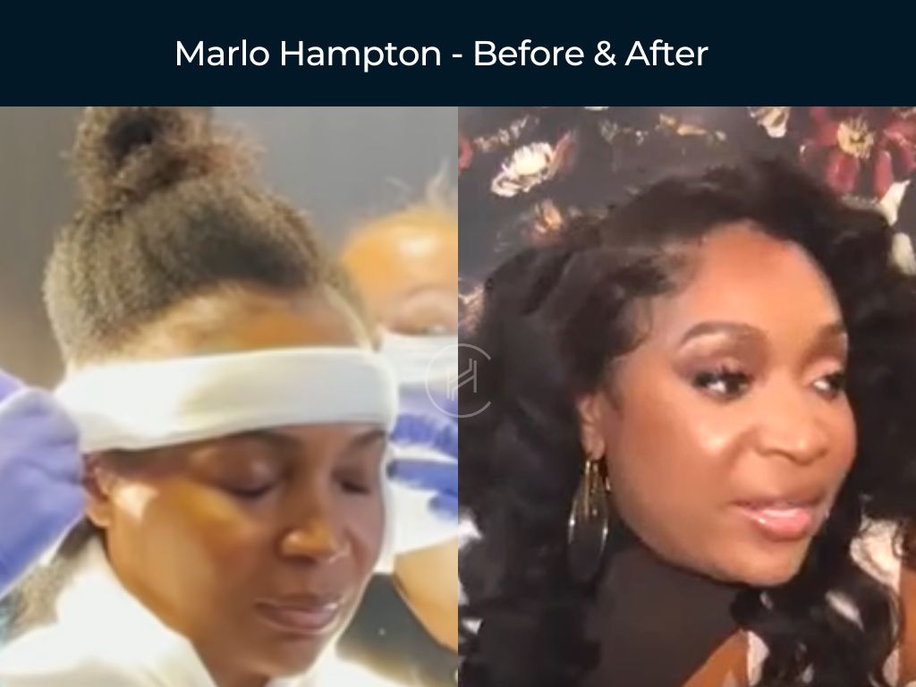 Marlo Hampton - Hair Transplant Before & After