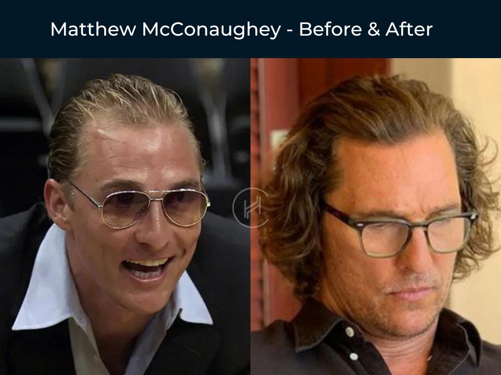 Matthew McConaughey - Hair Transplant Before & After