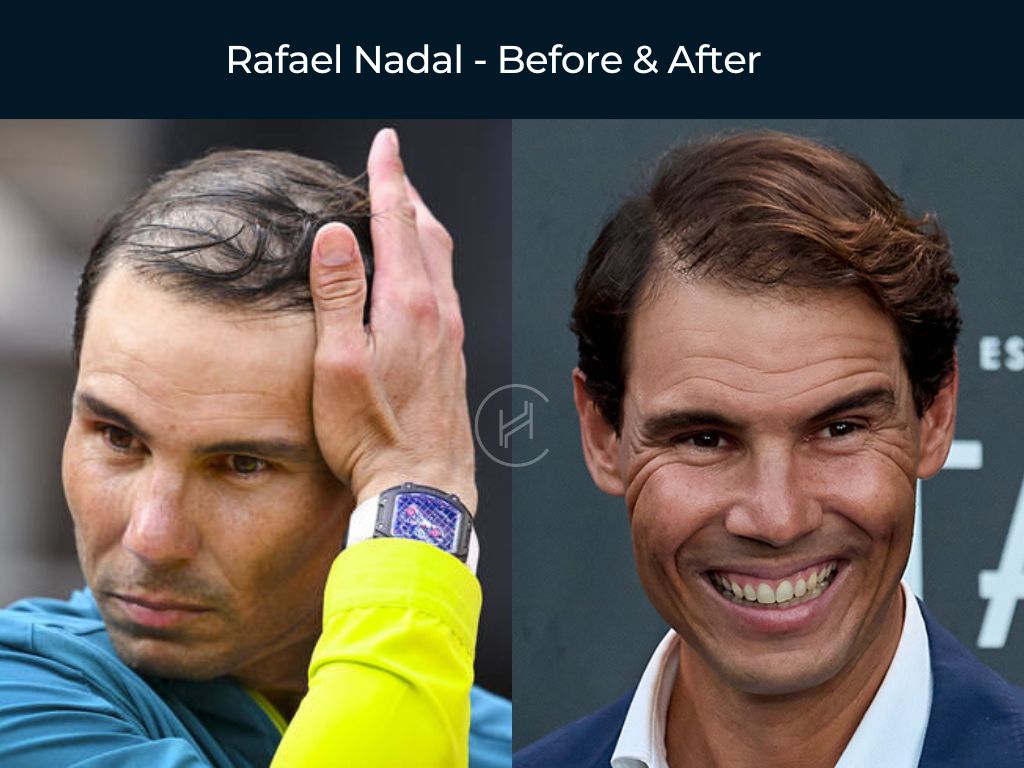 Rafael Nadal - Hair Transplant Before & After