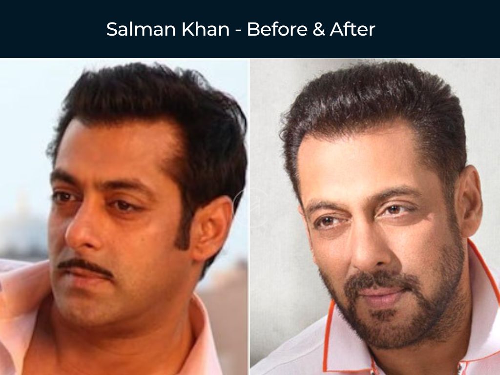 Salman Khan - Hair Transplant Before & After
