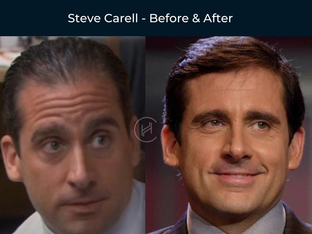 Steve Carell - Hair Transplant Before & After
