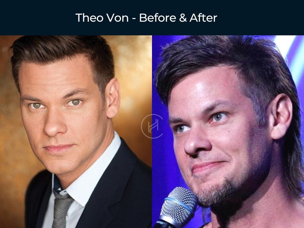 Theo Von - Hair Transplant Before & After