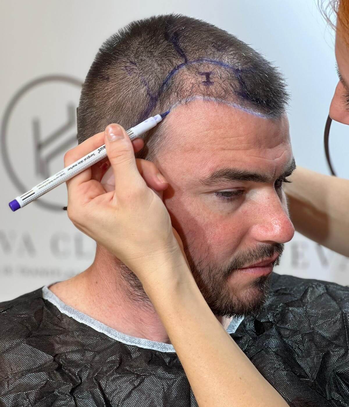 Diffuse Thinning Hair Transplant - Procedure & Cost - Heva Clinic