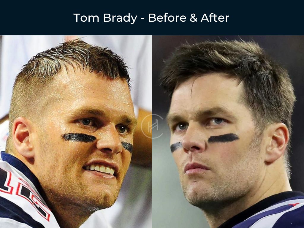 Tom Brady - Hair Transplant Before & After