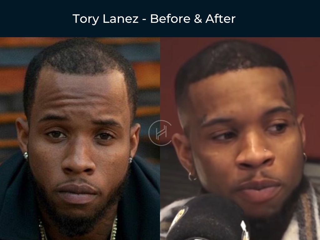 Tory Lanez - Hair Transplant Before & After