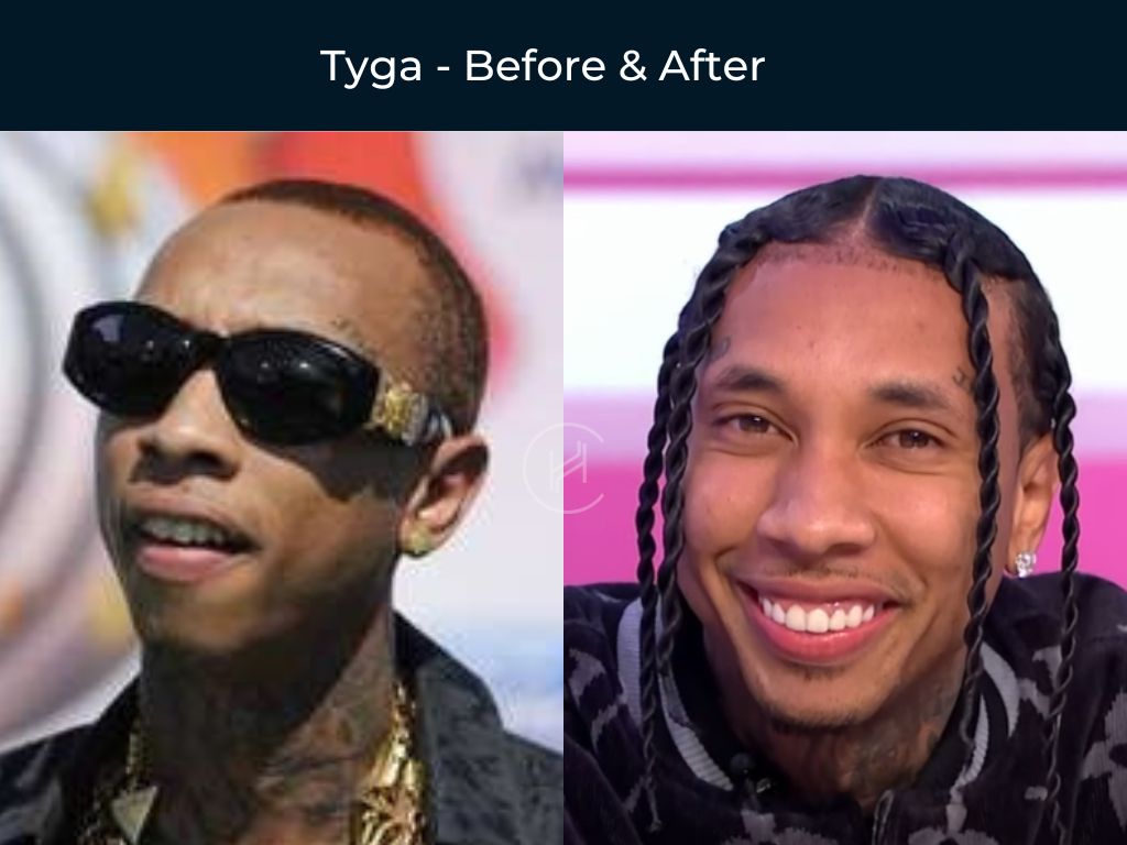 Tyga - Hair Transplant Before & After