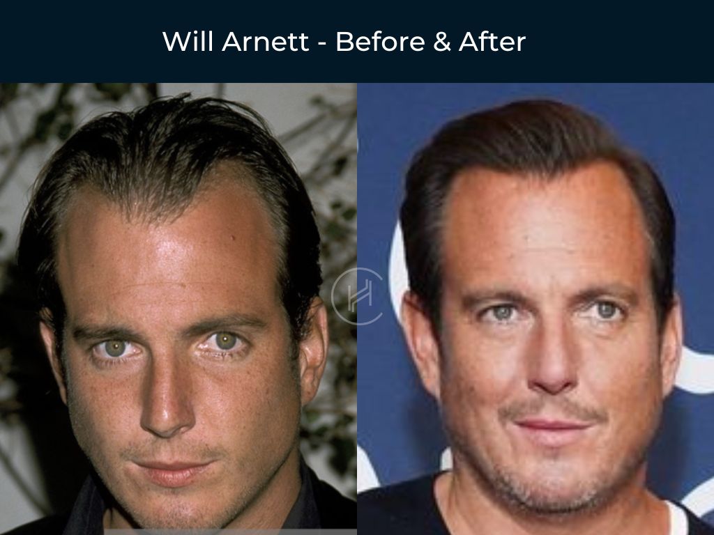 Will Arnett - Hair Transplant Before & After