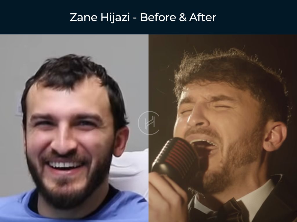 Zane Hijazi - Hair Transplant Before & After