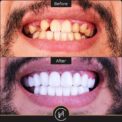 dental implants and hollywood smile before after