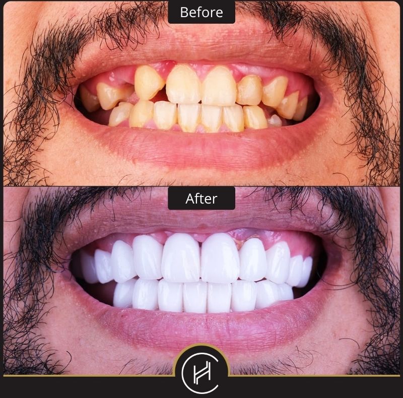 tooth implant before after