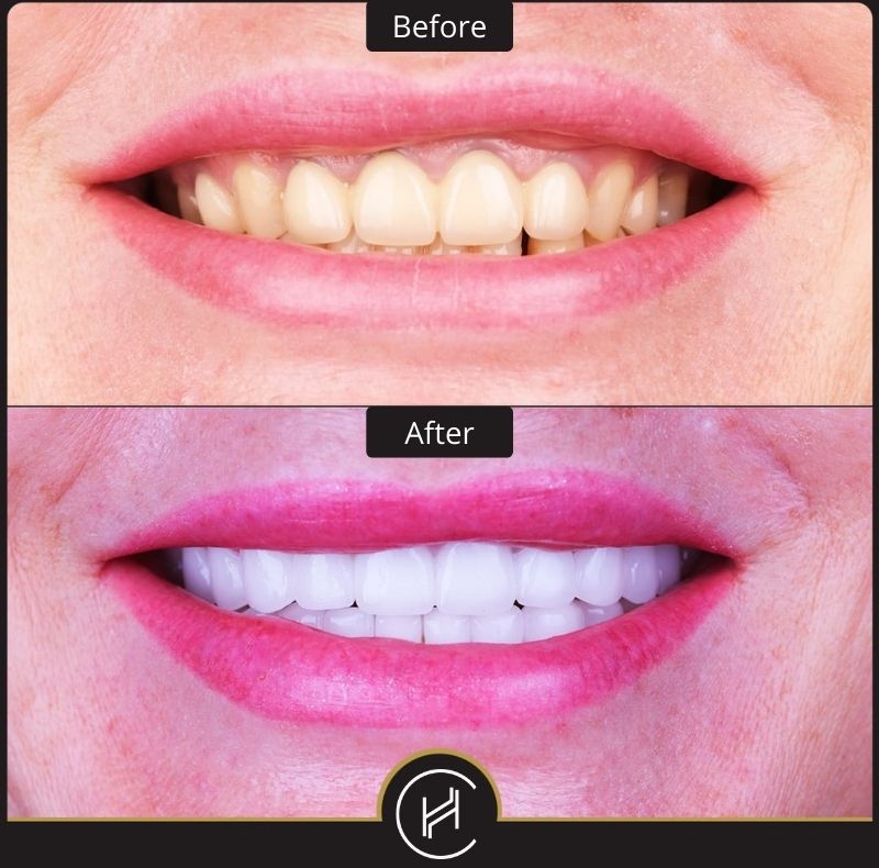 dental veneer and teeth whitening before after