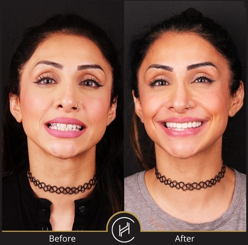 dental zirconium crowns treatment before after female
