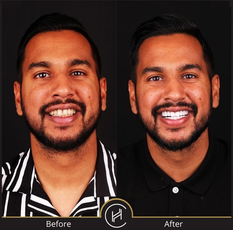 dental zirconium crowns treatment before after