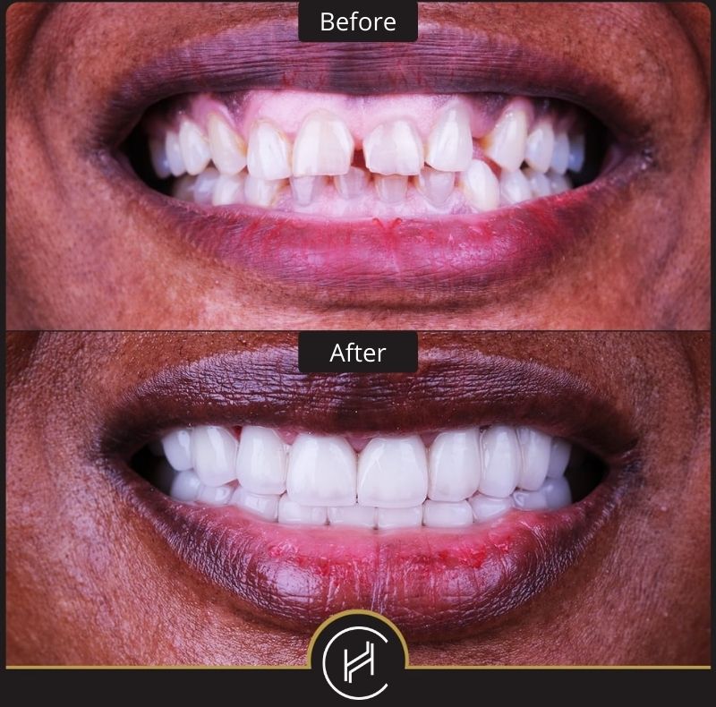 hollywood smile and gum leveling treatment before after