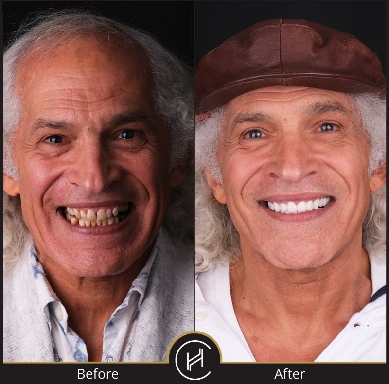 hollywood smile dental treatment male before after