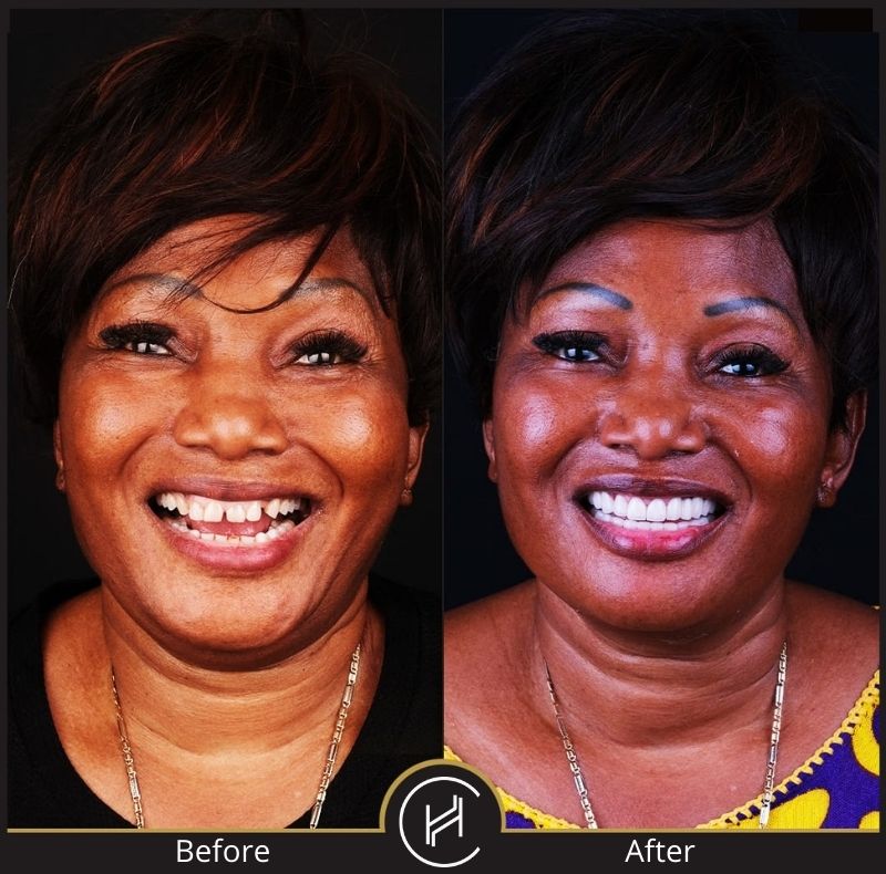 hollywood smile dental treatment teeth female before after
