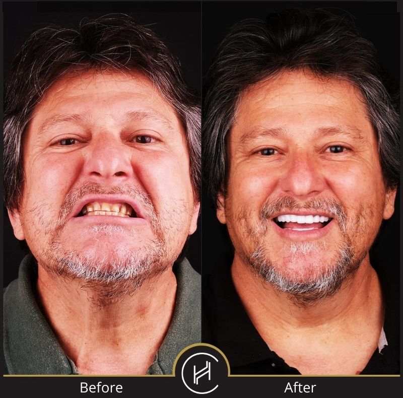 hollywood smile makeover before after