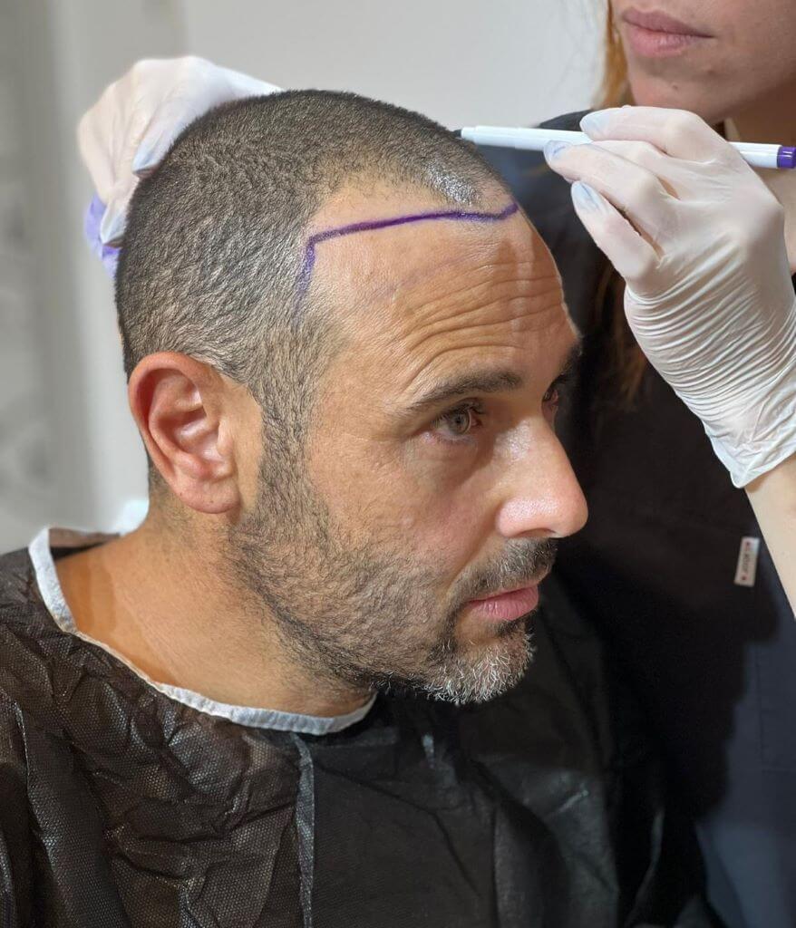 modern hair transplant hairline design at heva clinic