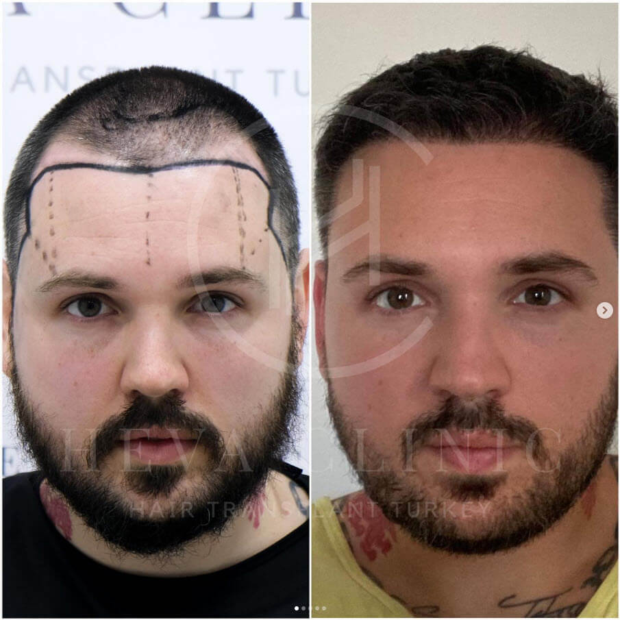 3000 grafts fue hair transplant patient before and after at heva clinic istanbul turkey
