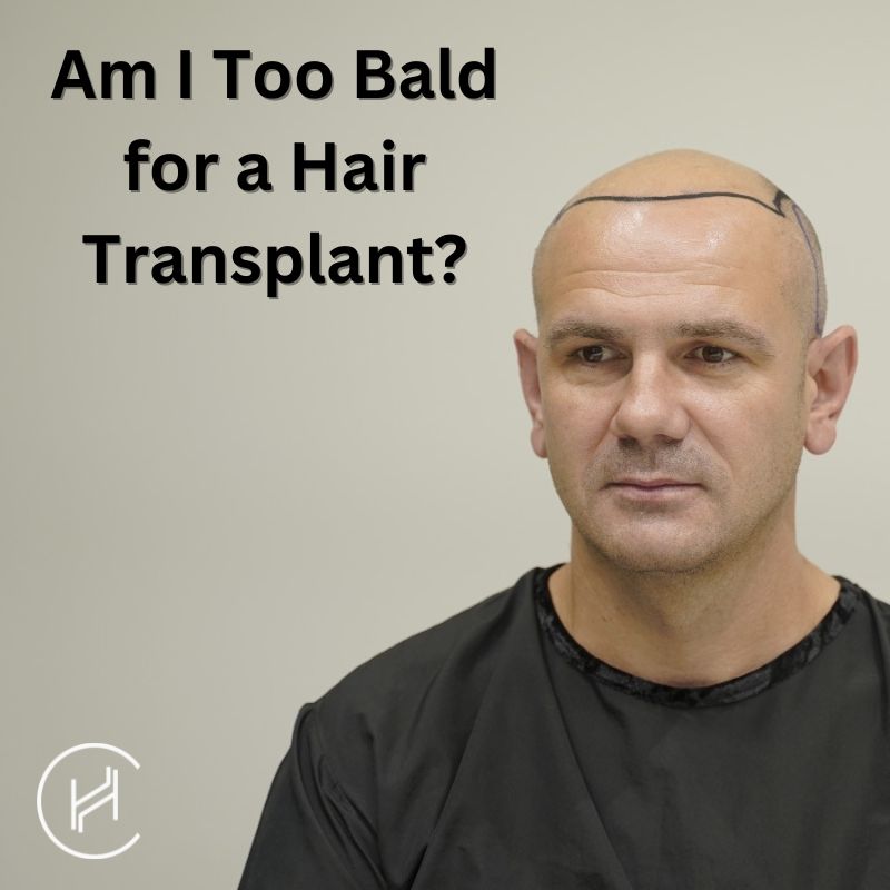 Am I Too Bald for a Hair Transplant: