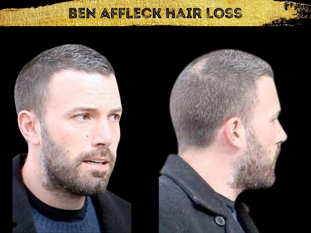 Ben Affleck Hair Loss front and back side of the head