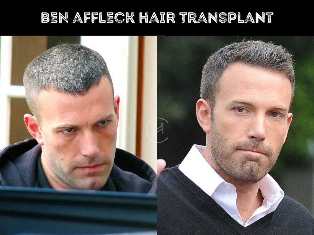 Ben Affleck Hair Transplant Before and After Photo