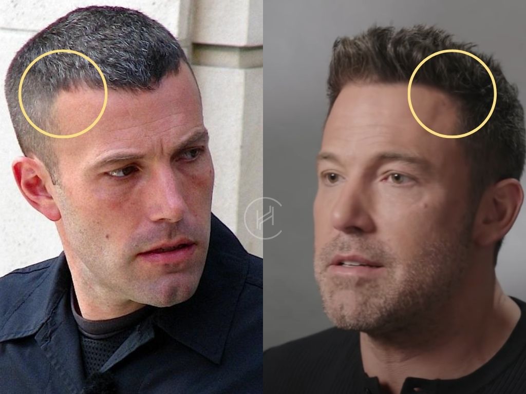 Ben Affleck Hair Transplant Before and After Temple Area