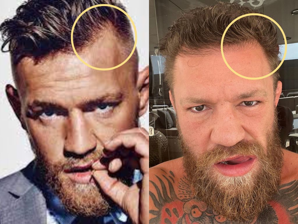 Conor McGregor Hair Transplant Hairline Before & After