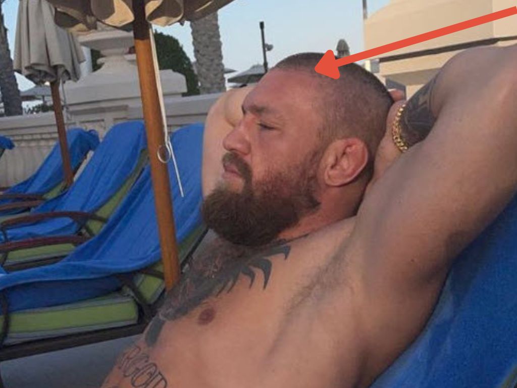 Conor McGregor Sunbathing Hair Transplant Hairline
