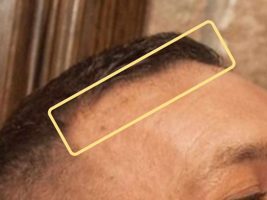 Conor McGregor after hair transplant frontline closeup