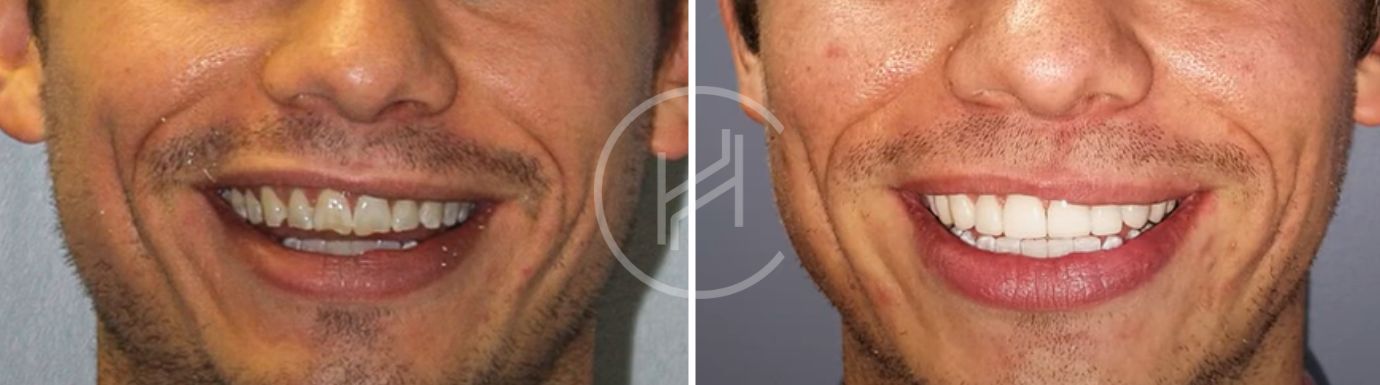 Dental Lumineers Male Patient Before After