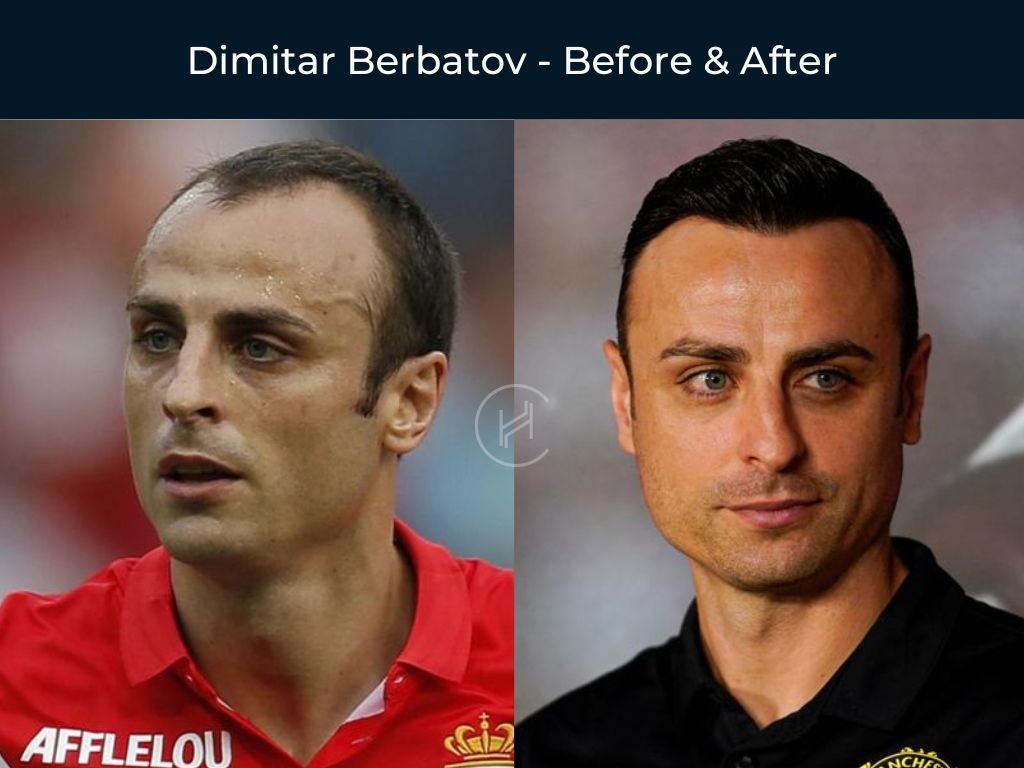 Dimitar Berbatov - Hair Transplant Before & After