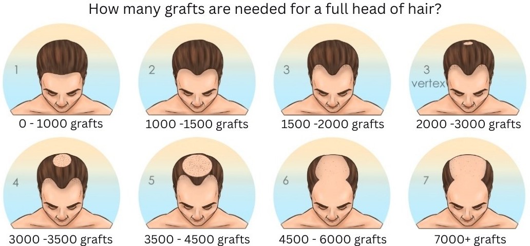 How many grafts are needed for a full head of hair