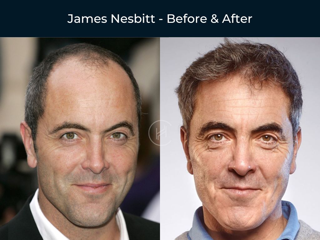 James Nesbitt - Hair Transplant Before & After