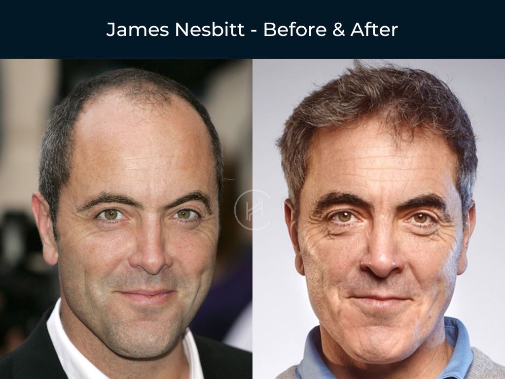 59 Celebrity Hair Transplants