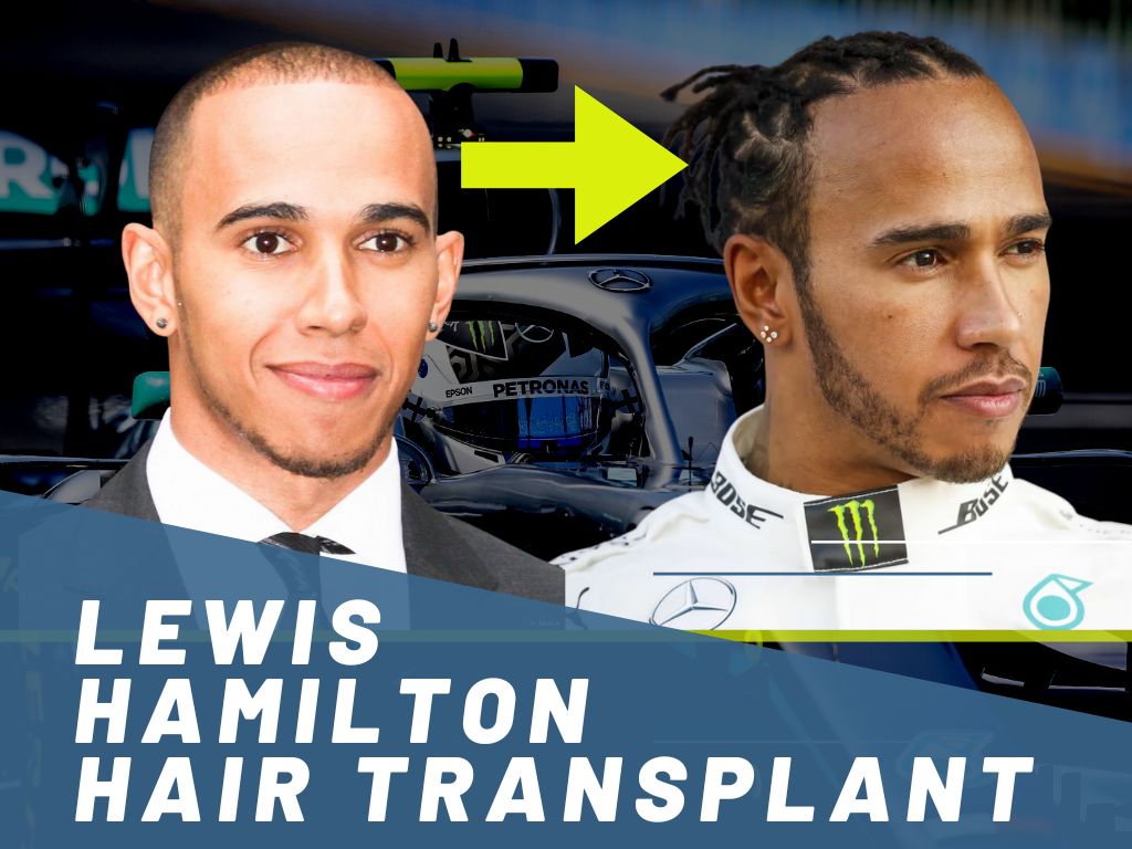 Lewis Hamilton Hair Transplant banner