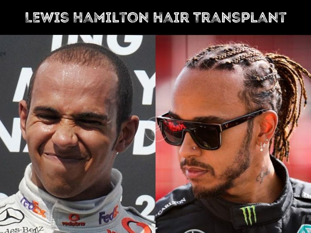 Lewis Hamilton before and after hair transplant result