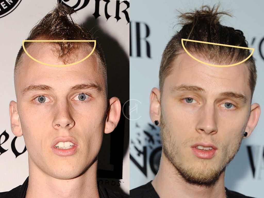 Machine Gun Kelly Hair Transplant Before and After Result