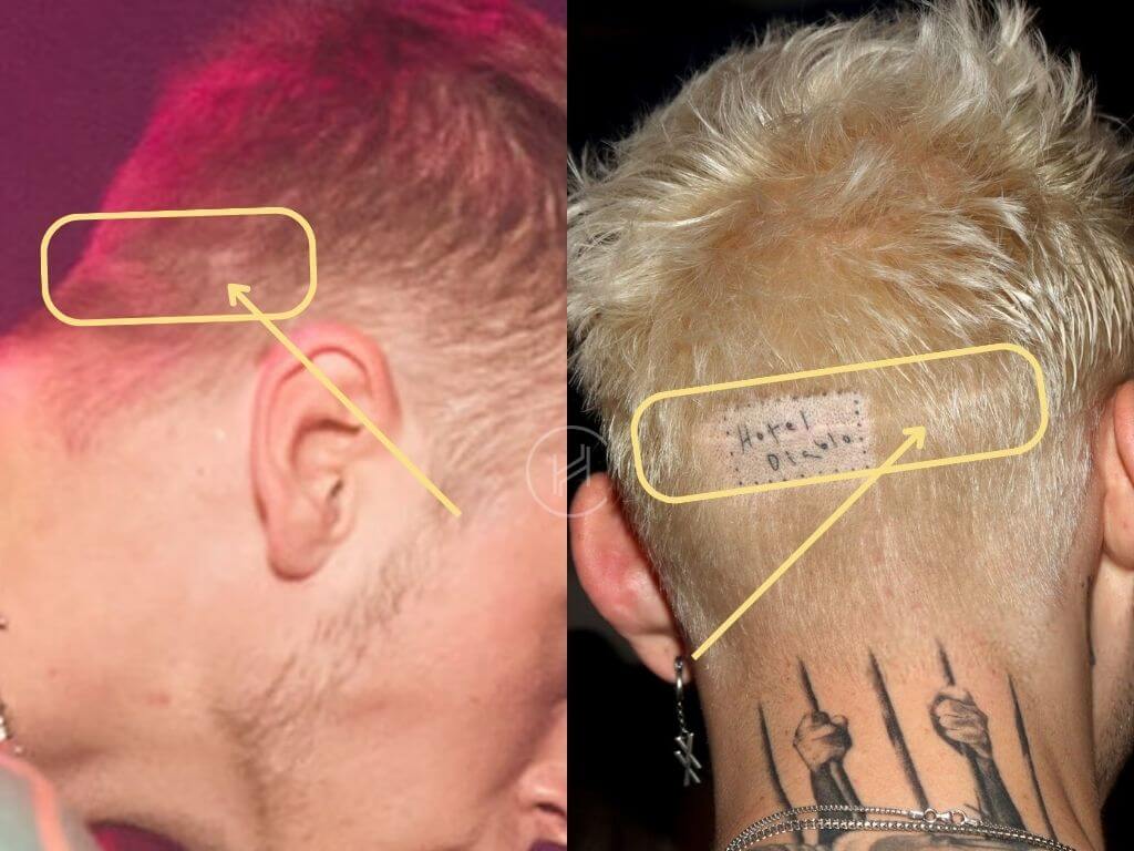 Machine Gun Kelly Hair Transplant Scars