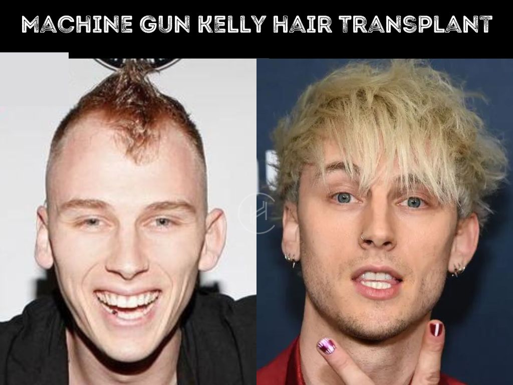 Machine Gun Kelly (MGK) Hair Transplant - Hair Loss Stages