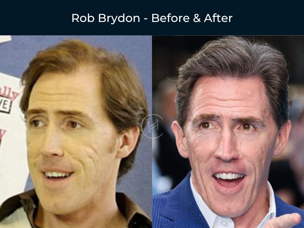 Rob Brydon - Hair Transplant Before & After