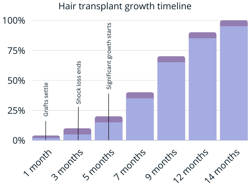 after hair transplant growth timeline chart