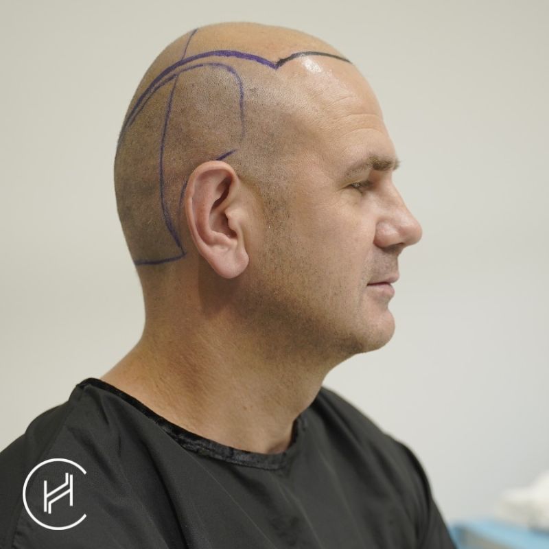 completely bald hair transplant candidate